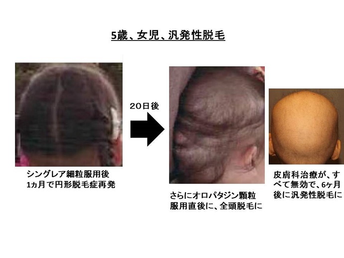 円形脱毛症　病院""